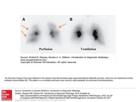 (A) Perfusion image of the lungs obtained in the anterior view demonstrates large segmental defects bilaterally (arrows), which are not matched by similar.