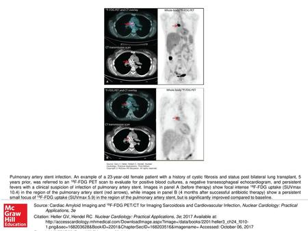 Pulmonary artery stent infection