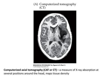 Angiogram—X-ray of head with dye present in cerebral blood vessels