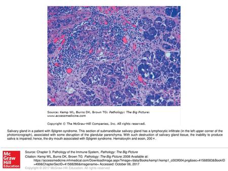 Salivary gland in a patient with Sjögren syndrome