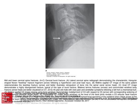 Mid and lower cervical spine fractures. (A–C) Cervical burst fracture