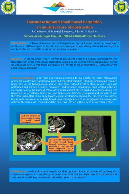 Transmesosigmoid small bowel herniation,