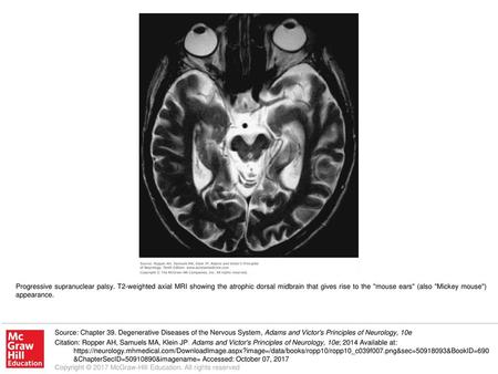 Progressive supranuclear palsy