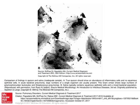 Comparison of findings in sputum and saliva (inadequate sample)