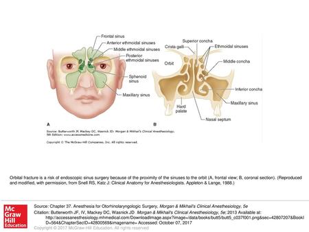 Orbital fracture is a risk of endoscopic sinus surgery because of the proximity of the sinuses to the orbit (A, frontal view; B, coronal section). (Reproduced.