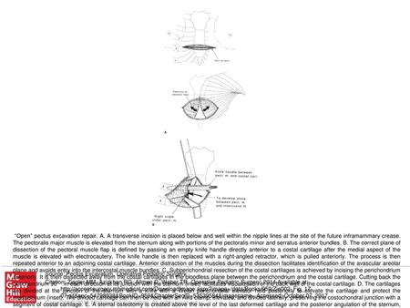 “Open” pectus excavation repair. A