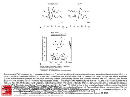 Examples of oVEMP responses to bone-conducted vibration at Fz in healthy subjects (A) and a patient with a complete unilateral vestibular loss (B). In.