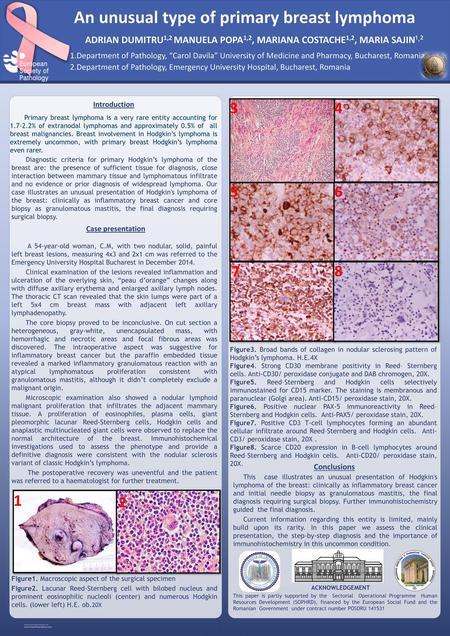 An unusual type of primary breast lymphoma