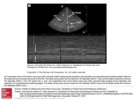 (a) Transverse view of the inferior vena cava (IVC) using M-mode imaging during inspiration and expiration of a spontaneously breathing patient. Note the.