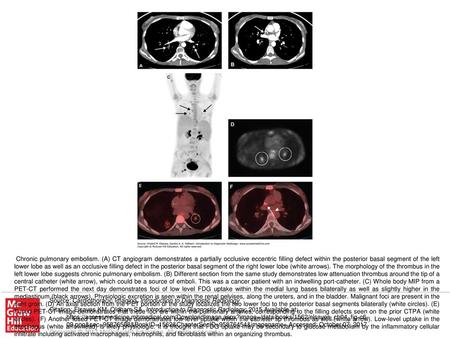 Chronic pulmonary embolism