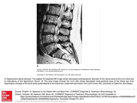 A: Degenerative spinal stenosis