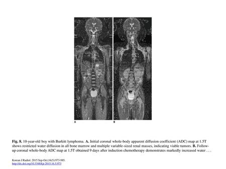 Fig year-old boy with Burkitt lymphoma. A