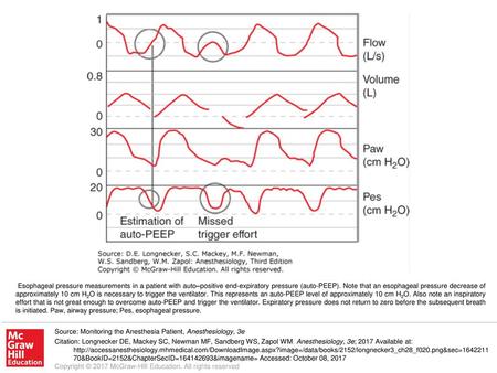 Esophageal pressure measurements in a patient with auto–positive end-expiratory pressure (auto-PEEP). Note that an esophageal pressure decrease of approximately.