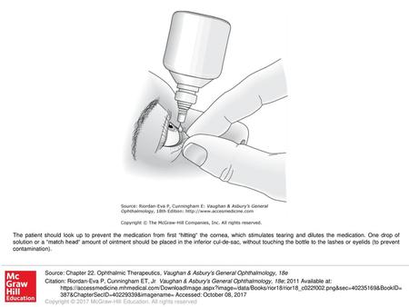 The patient should look up to prevent the medication from first “hitting“ the cornea, which stimulates tearing and dilutes the medication. One drop of.