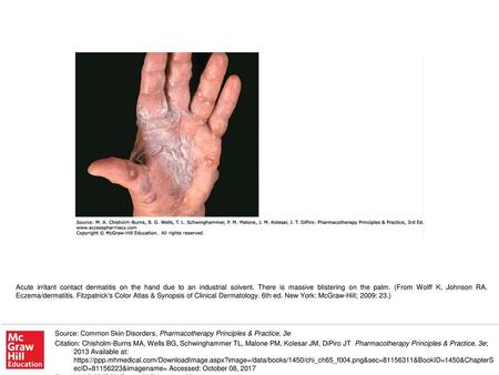 Acute irritant contact dermatitis on the hand due to an industrial solvent. There is massive blistering on the palm. (From Wolff K, Johnson RA. Eczema/dermatitis.