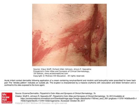 Acute irritant contact dermatitis following application of a cream containing nonylvanillamid and nicotinic acid butoxyethyl ester prescribed for lower.