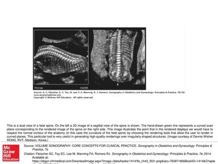 This is a dual view of a fetal spine