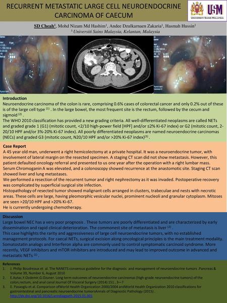 RECURRENT METASTATIC LARGE CELL NEUROENDOCRINE CARCINOMA OF CAECUM