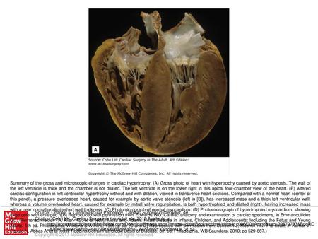 Summary of the gross and microscopic changes in cardiac hypertrophy