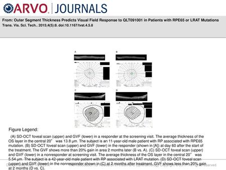 From: Outer Segment Thickness Predicts Visual Field Response to QLT091001 in Patients with RPE65 or LRAT Mutations Trans. Vis. Sci. Tech.. 2015;4(5):8.