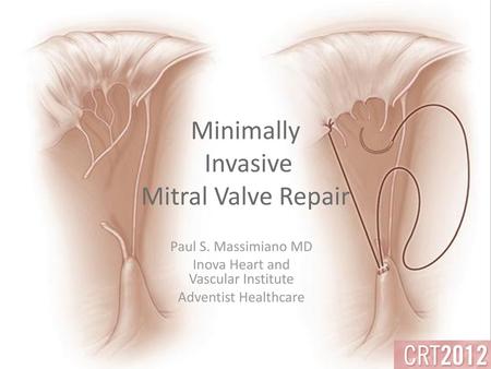 Minimally Invasive Mitral Valve Repair