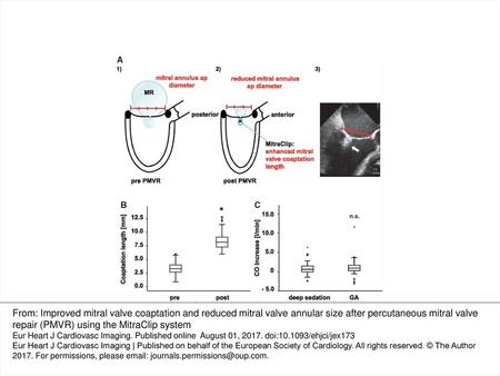 Figure 1 Changes of mitral valve geometry caused by PMVR