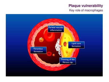 Plaque vulnerability Key role of macrophages