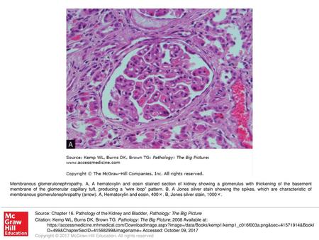 Membranous glomerulonephropathy