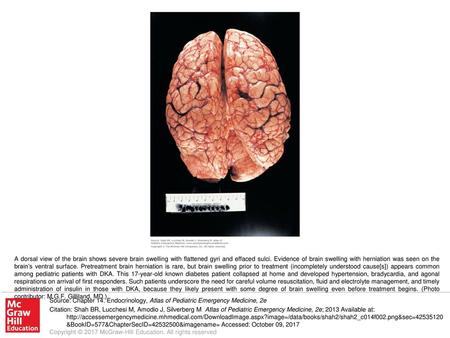 A dorsal view of the brain shows severe brain swelling with flattened gyri and effaced sulci. Evidence of brain swelling with herniation was seen on the.