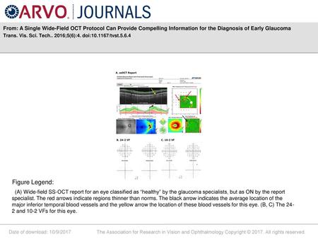 From: A Single Wide-Field OCT Protocol Can Provide Compelling Information for the Diagnosis of Early Glaucoma Trans. Vis. Sci. Tech.. 2016;5(6):4. doi:10.1167/tvst.5.6.4.