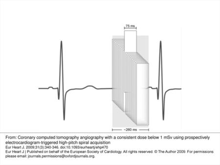 Figure 1 Image reconstruction in prospectively ECG-triggered high-pitch spiral coronary CT angiography using dual-source CT. The entire period of data.