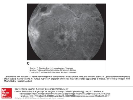 Central retinal vein occlusion