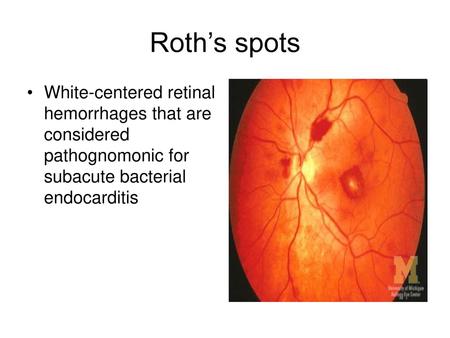 Roth’s spots White-centered retinal hemorrhages that are considered pathognomonic for subacute bacterial endocarditis.