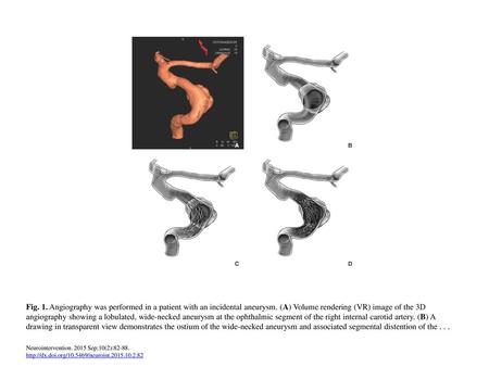 Fig. 1. Angiography was performed in a patient with an incidental aneurysm. (A) Volume rendering (VR) image of the 3D angiography showing a lobulated,