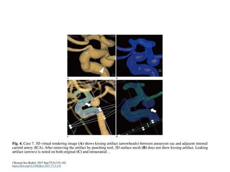 Fig. 4. Case 7. 3D virtual rendering image (A) shows kissing artifact (arrowheads) between aneurysm sac and adjacent internal carotid artery (ICA). After.