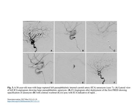 Fig. 3. A 38-year-old man with large ruptured left paraophthalmic internal carotid artery (ICA) aneurysm (case 7). (A) Lateral view of left ICA angiogram.