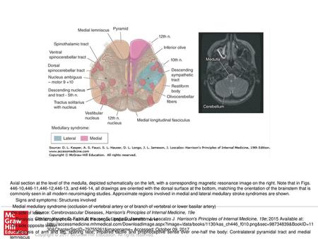 Paralysis or weakness of all extremities, plus all bulbar musculature: Corticobulbar and corticospinal tracts bilaterally Source: Cerebrovascular Diseases,