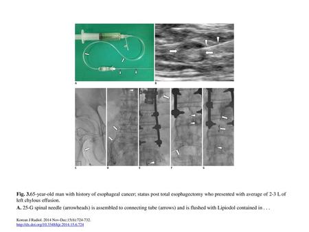 Fig. 3.65-year-old man with history of esophageal cancer; status post total esophagectomy who presented with average of 2-3 L of left chylous effusion.