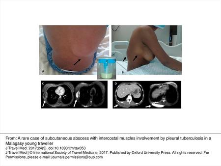 Figure 1 Clinical presentation: dorsal (a) and paramedian (b) masses localized in the right side of the thorax. CT and MRI of the chest without and with.