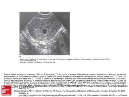 Normal 5-week intrauterine pregnancy (IUP)