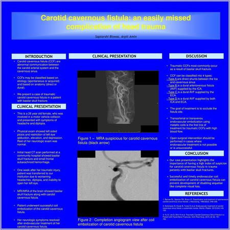 Carotid cavernous fistula: an easily missed