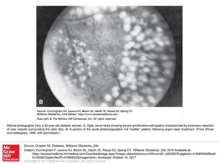 Retinal photographs from a 30-year-old diabetic woman. A