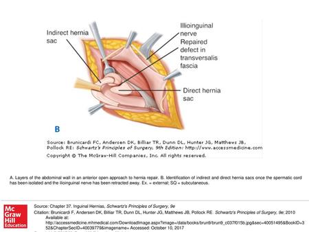 A. Layers of the abdominal wall in an anterior open approach to hernia repair. B. Identification of indirect and direct hernia sacs once the spermatic.