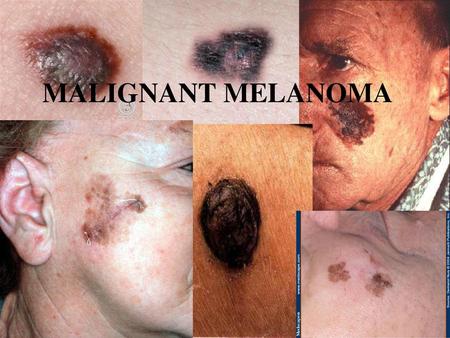 MALIGNANT MELANOMA.