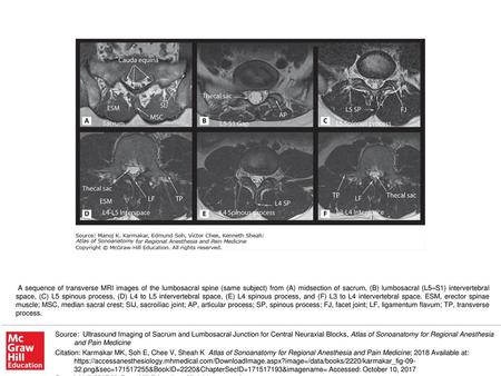 A sequence of transverse MRI images of the lumbosacral spine (same subject) from (A) midsection of sacrum, (B) lumbosacral (L5–S1) intervertebral space,