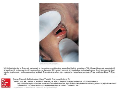 (A) Conjunctivitis due to Chlamydia trachomatis is the most common infectious cause of ophthalmia neonatorum. This 10-day-old neonate presented with lid.