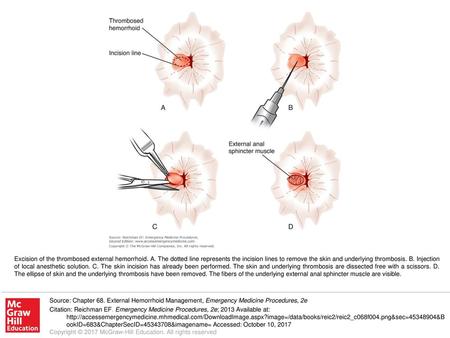 Excision of the thrombosed external hemorrhoid. A