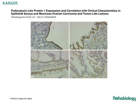 Podocalyxin-Like Protein 1 Expression and Correlation with Clinical Characteristics in Epithelial Serous and Mucinous Ovarian Carcinoma and Tumor-Like.