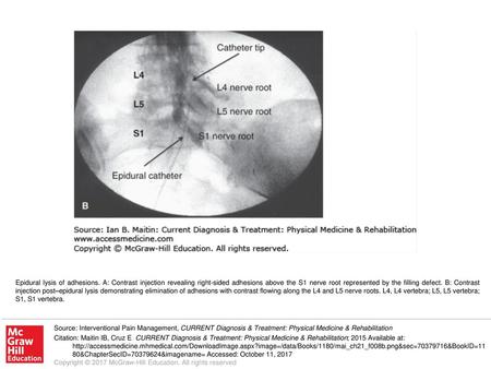 Epidural lysis of adhesions