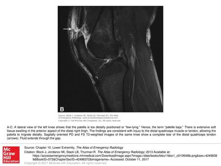 A-C: A lateral view of the left knee shows that the patella is too distally positioned or “low-lying.” Hence, the term “patella baja.” There is extensive.